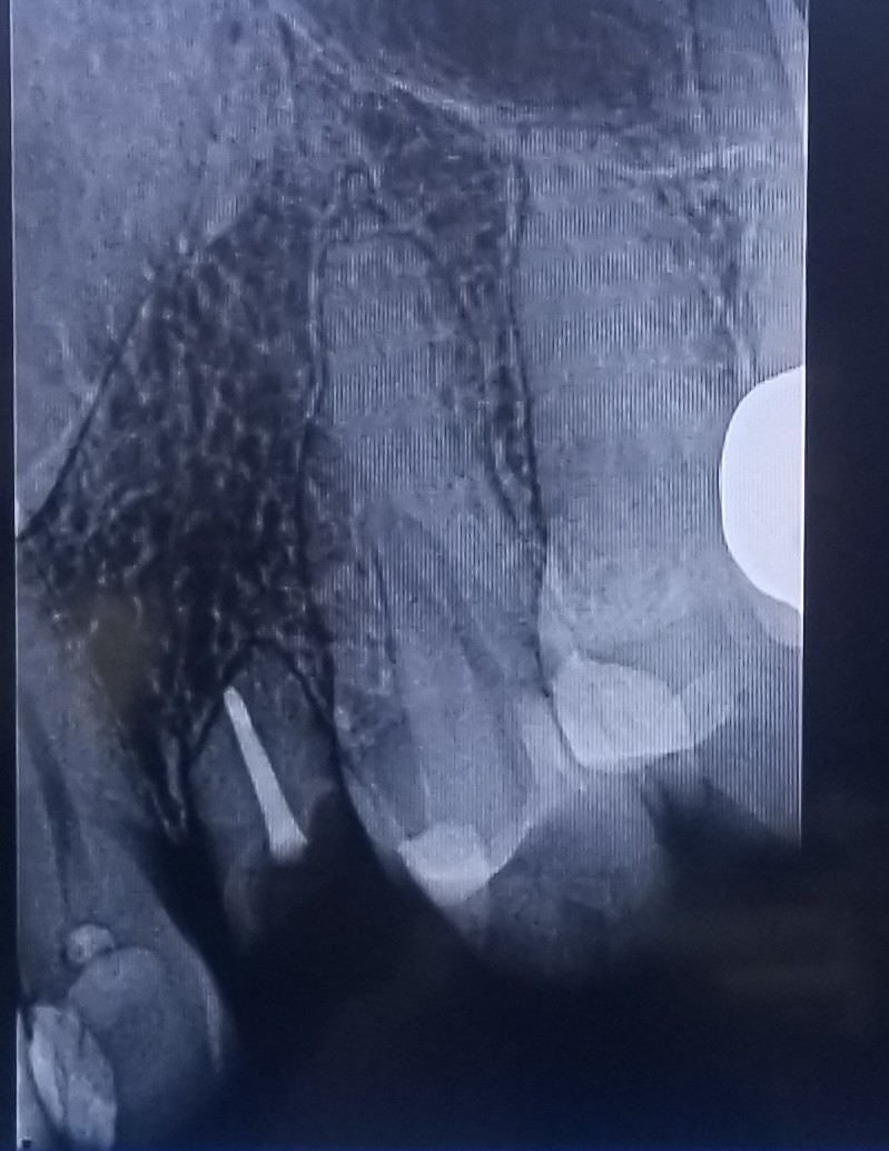 foxyinktattoo's tweet photo. whoever was responsible for distributing my teeth just sprinkled them randomly around my head, some stuck in my upper palate, so this baby tooth never got pushed out and lasted way beyond its time. look at its tiny root all root-canaled! now it's all that's left. #crazyteeth https://t.co/JZ7PAjYLpG