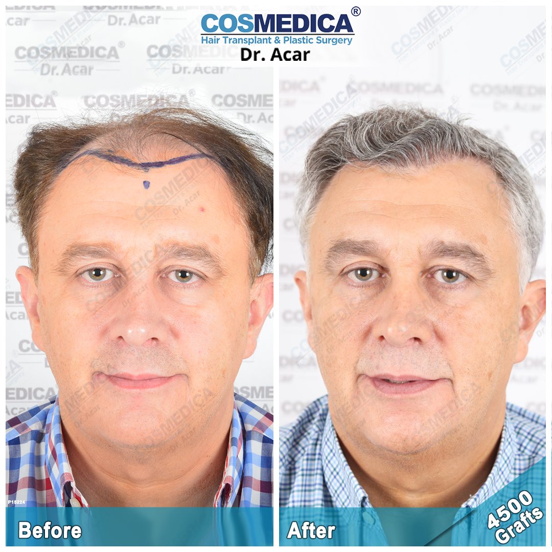Uzivatel Cosmedica Clinic Na Twitteru Hair Transplant With 4500 Grafts The Best Results Are Achieved With Dr Acar At Cosmedica Clinic In Turkey Contact 90 544 556 05 55