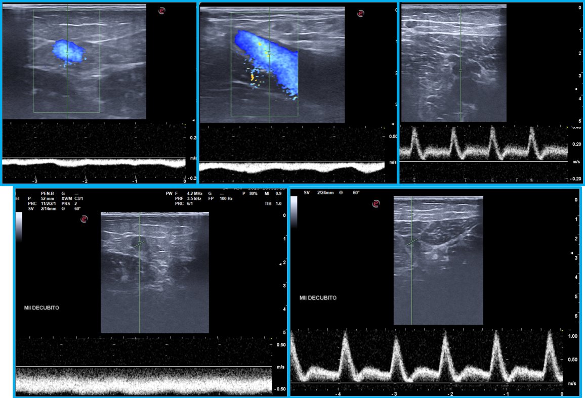 No todas las varices tronculares voluminosas son de origen primario. Cuidado. Si ecográficamente vemos -en bipedestación- un flujo venoso espontáneo intenso y baja resistencia diastólica arterial ... y estos aumentan en decúbito, podemos tener delante un Parkes Weber.
