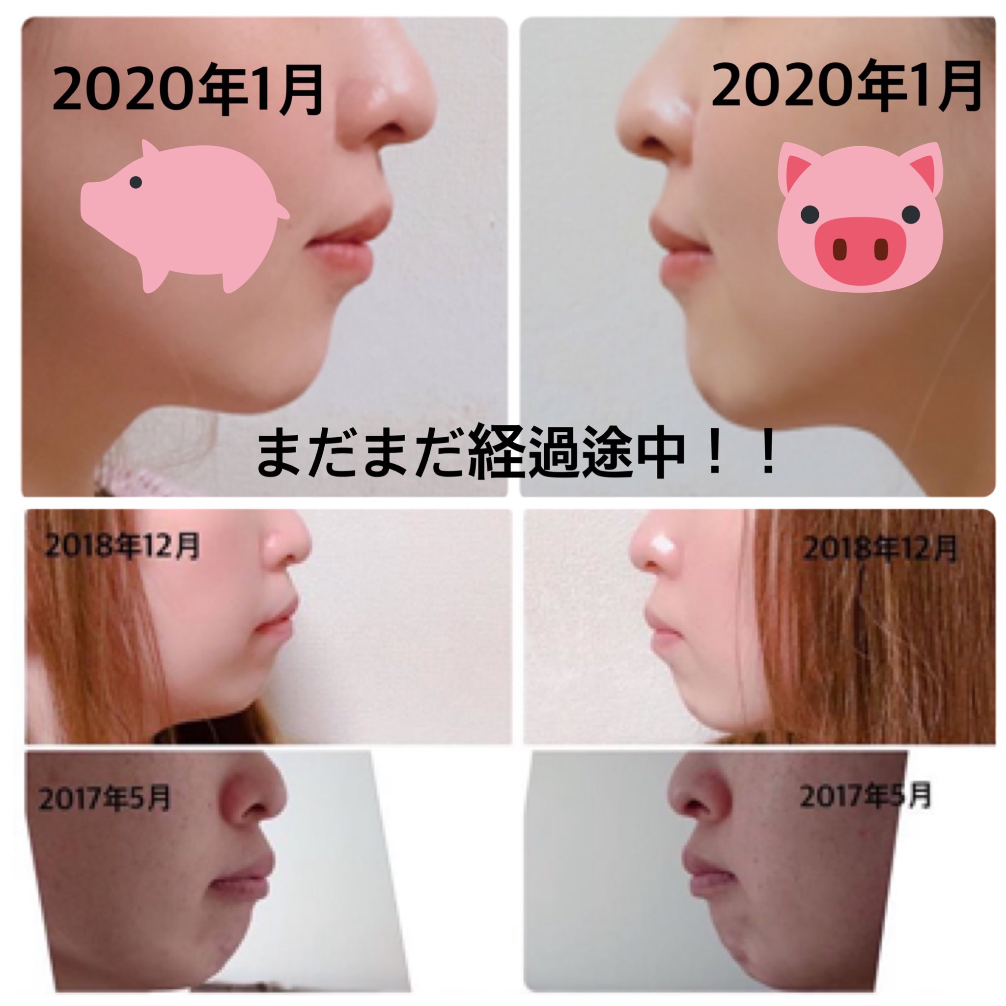 ぱねが 出っ歯 顎なし 歯列矯正 経過途中 口ゴボ 7本抜歯 顎梅干し 抜歯矯正 変化 ビフォーアフター 横顔ブス Part2 口元スッキリしてきたの嬉しい T Co Wmpvkqm7wl Twitter
