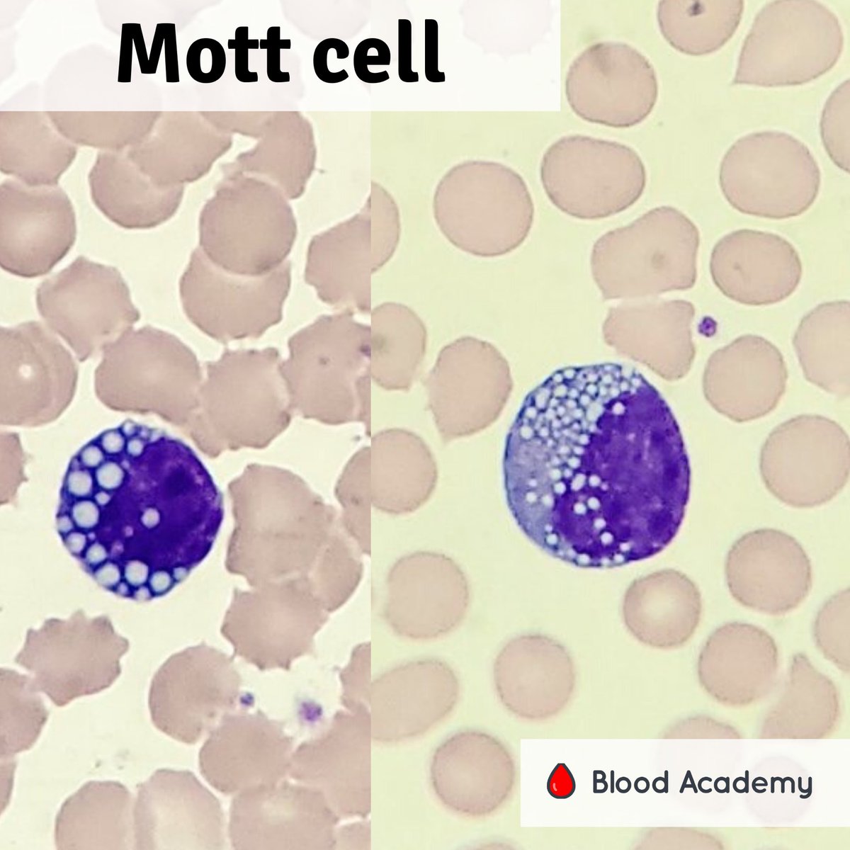 blood_academy's tweet photo. What is a Mott cell?
🔶plasma cell
🔶multiple round cytoplasmic inclusions composed of immunoglobulin (Russell bodies)
🔶 derived from rough endoplasmic reticulum
🔶found in both reactive plasmacytosis and malignant plasma cell disorders (myeloma, lymphoplasmacytoid lymphoma) https://t.co/hsdrME6wla