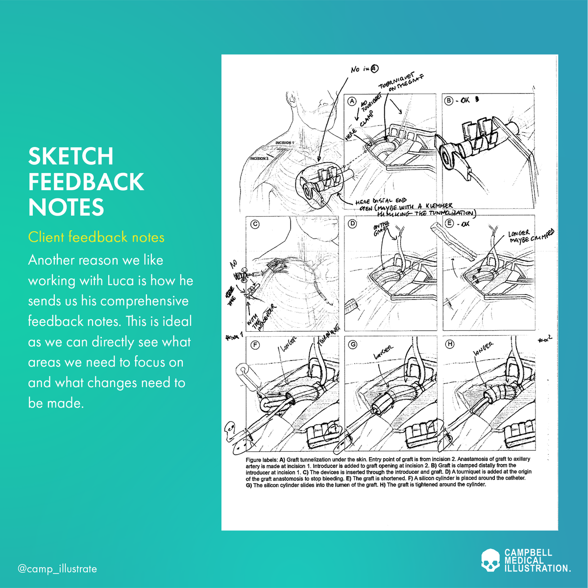nowmedstudios's tweet photo. Last year we shared our process on how we developed this #medicalillustration, but we did not share the client side of how @lucabertoglio contributes. Check out our process here and read all about the collaborative process! Link to paper: https://t.co/T86mhf3Vql https://t.co/51SD8CBtky