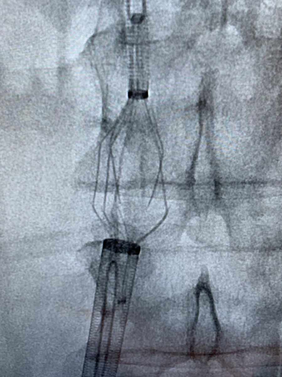 Watts_IR's tweet photo. 9 y/o Trapease with sudden thrombosis of both legs to the ankles. Give me some @MdPetruzzi and Zelante to clear it all out, a dry-seal sheath to #GTFO, @PhilipsHealth IVUS, with Vici and Wallstent to clean up the mess. Single session marathon! @bsc_pi #irad #5AccessSites https://t.co/DqZgsYM1y8