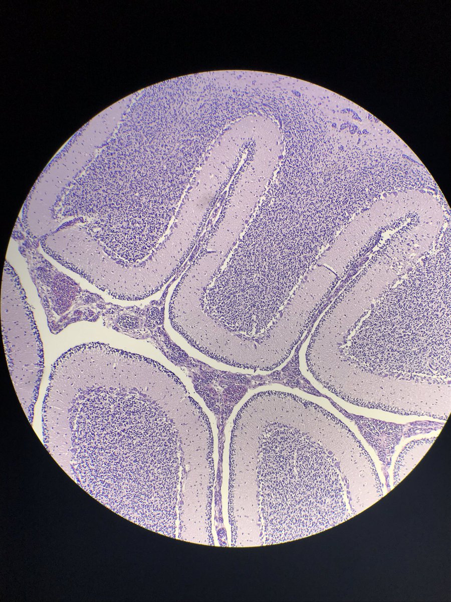 seattlequinns's tweet photo. Not what I was expecting. 5wk infant boy witnessed to go unresponsive, CPR immed, no ROSC. NSVD at term. Breastfed. 4 healthy siblings. At #autopsy pancreas replaced by mass, HSM, + other findings. What do you want to know about this kiddo? #forensicpath #pedipath #suid #hemepath https://t.co/8TgpqpsuEd