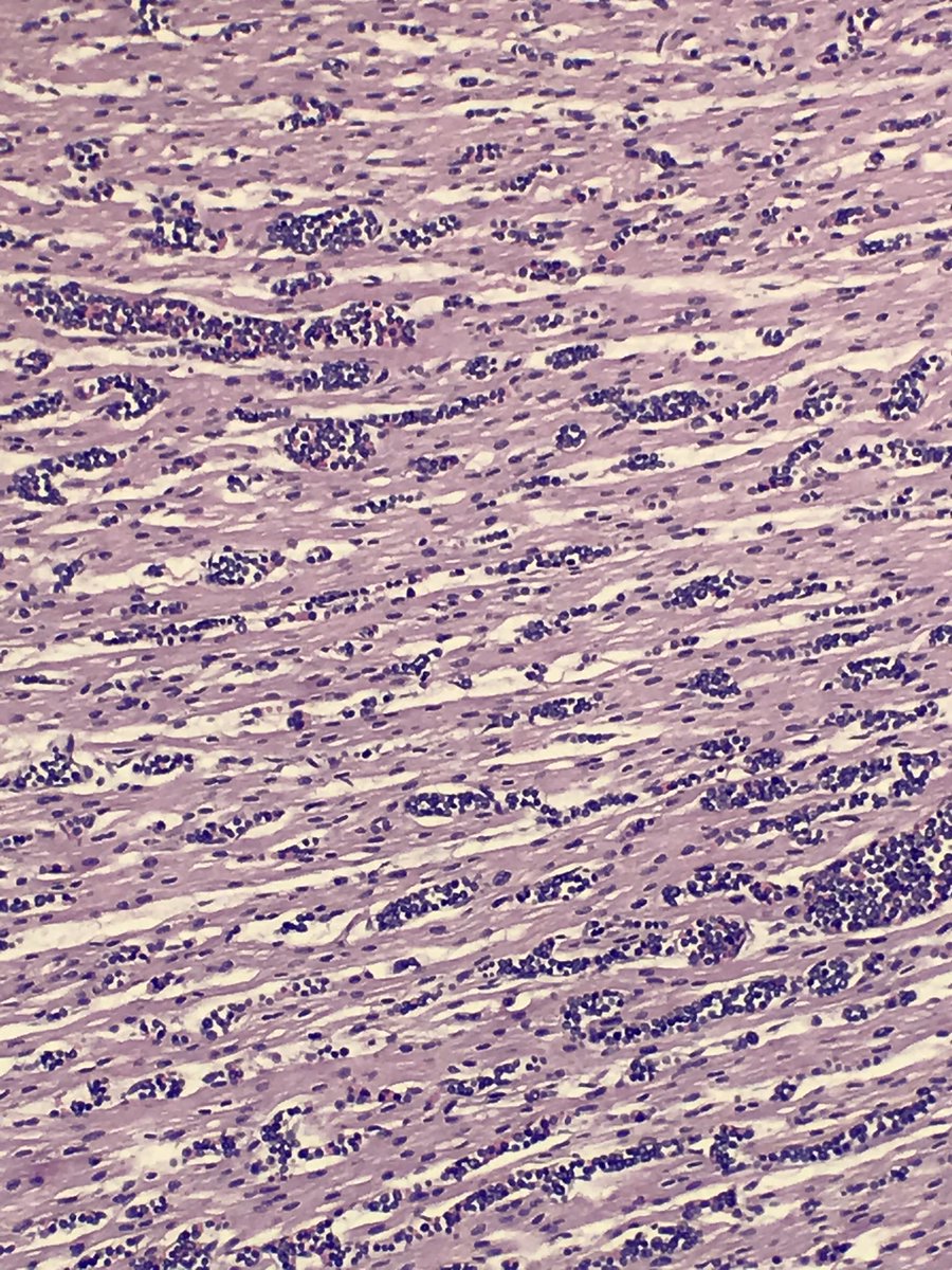 seattlequinns's tweet photo. Not what I was expecting. 5wk infant boy witnessed to go unresponsive, CPR immed, no ROSC. NSVD at term. Breastfed. 4 healthy siblings. At #autopsy pancreas replaced by mass, HSM, + other findings. What do you want to know about this kiddo? #forensicpath #pedipath #suid #hemepath https://t.co/8TgpqpsuEd