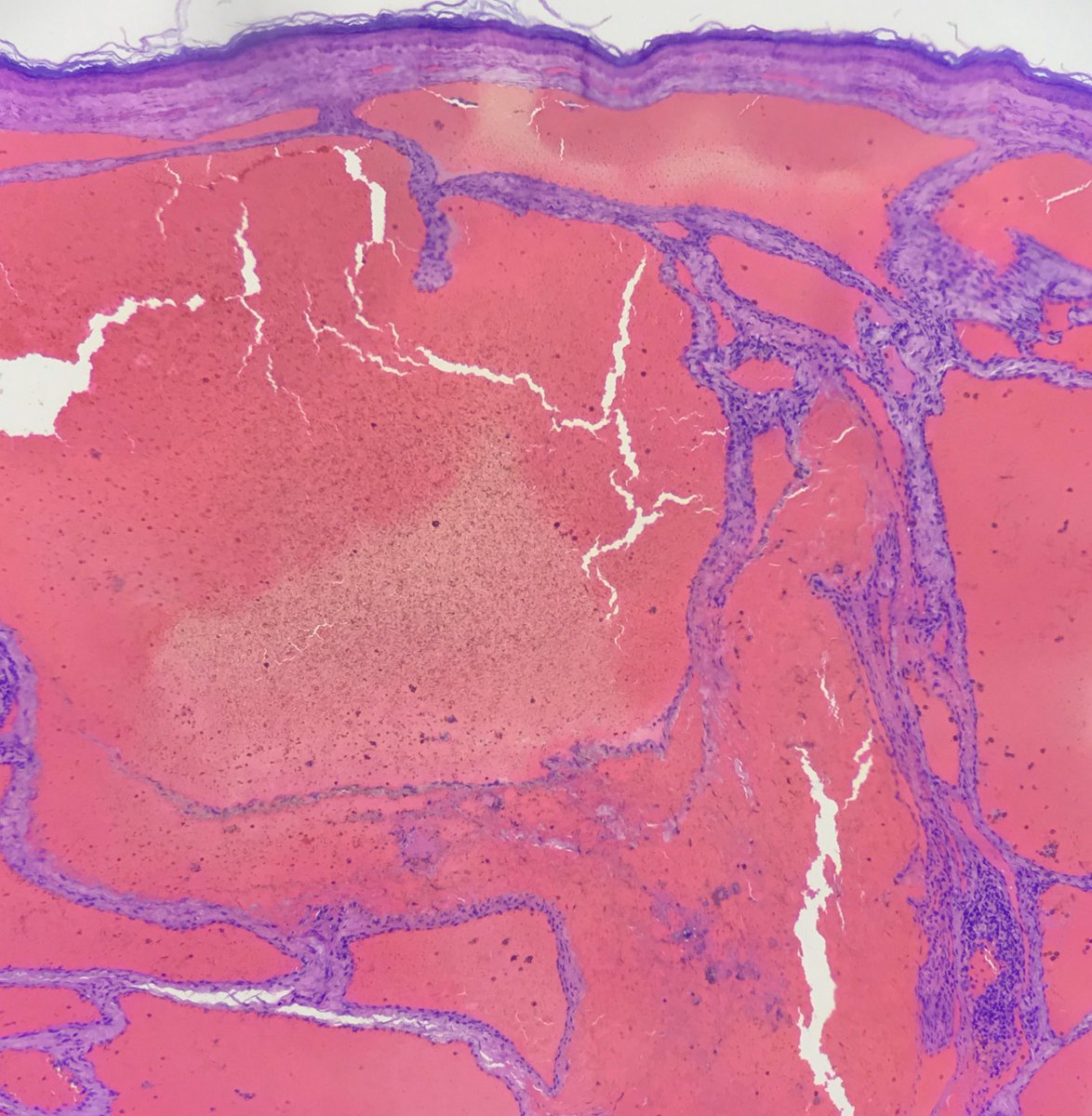 LizaAriasT's tweet photo. #DraLizaArias #Dermatopathology #Dermatopathologist #PathArt #LovingDermPath #Dermatopatóloga #Dermatóloga https://t.co/F35mBo2fM8