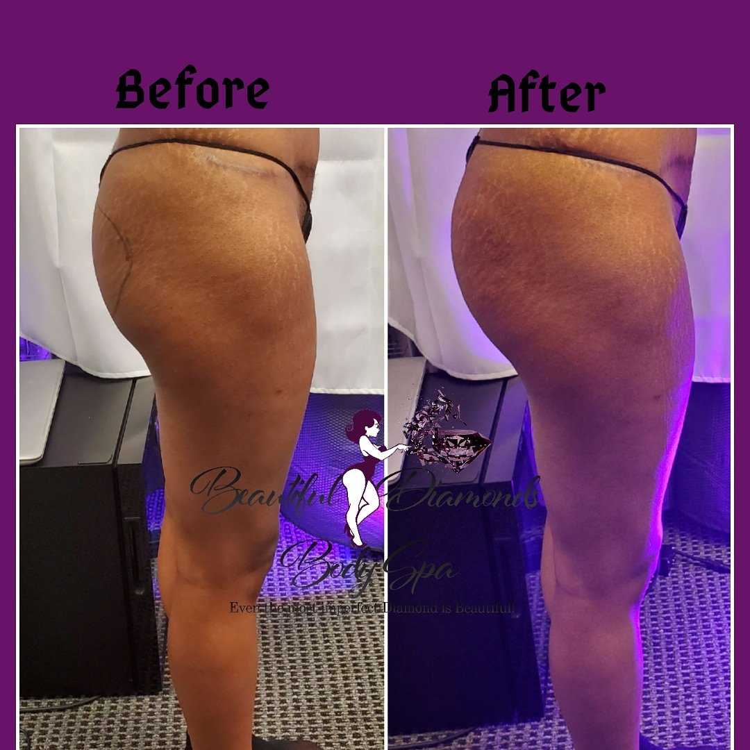 BDiamondBodySpa's tweet photo. Get it right get it tight! Houston's premier body contouring spa. Save your $ ! Avoid plastic surgery! All we need is 1 hour!
#houstonbuttlift #Houstonweightloss #houstonlipo #noninvasivelipo #noninvasivefatreduction
#houstoncavitation #buttlifthouston #buttlift #fatloss https://t.co/qQWHRhBoPf