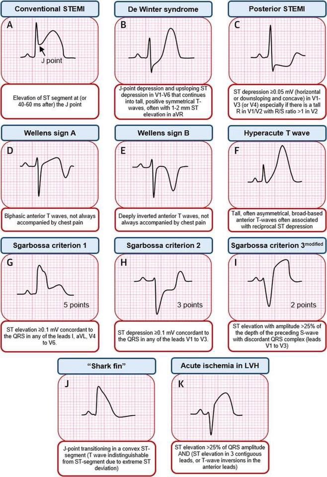 alemoyaal's tweet photo. Presentaciones isquemicas potencialmente mortales que debemos conocer #emergencypearls #ekg todas las aprendí en las charlas de un gran maestro y una gran persona @amalmattu y su #ekgweekly https://t.co/0R2fojfruh