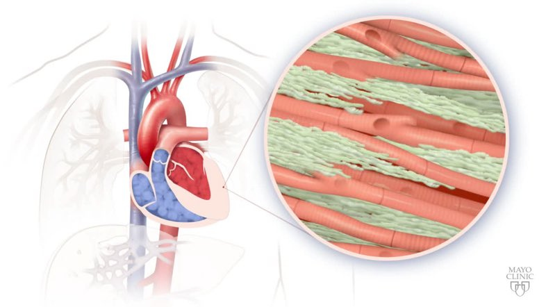 Martha Grogan MD (@marthagrogan1) on Twitter photo One year Cardiac #Amyloidosis fellowship <a href="/MayoClinic/">Mayo Clinic</a> starting July 2020. Clinical/research training in this not so rare disease. Flexible, multidisciplinary curriculum. No call!DM me if interested for this year or next. <a href="/maz_hanna/">Mazen Hanna</a> <a href="/BrettSperryMD/">Brett Sperry, MD</a> <a href="/Ron_Witteles/">Ronald Witteles</a> <a href="/HeitnerStephen/">Stephen Heitner</a> One year Cardiac #Amyloidosis fellowship <a href="/MayoClinic/">Mayo Clinic</a> starting July 2020. Clinical/research training in this not so rare disease. Flexible, multidisciplinary curriculum. No call!DM me if interested for this year or next. <a href="/maz_hanna/">Mazen Hanna</a> <a href="/BrettSperryMD/">Brett Sperry, MD</a> <a href="/Ron_Witteles/">Ronald Witteles</a> <a href="/HeitnerStephen/">Stephen Heitner</a>