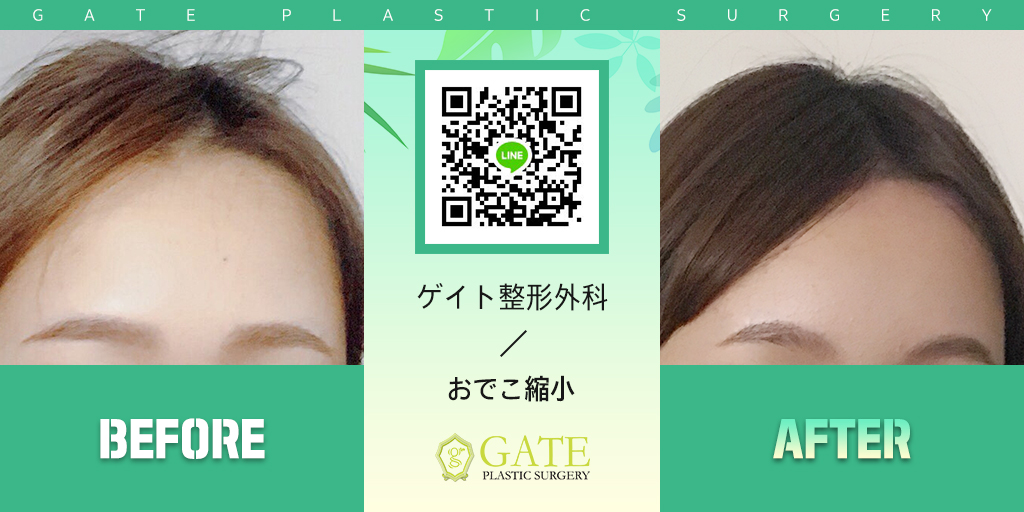 手術部位：#額縮小

手術方法：HD内視鏡を使い内部組織の損傷を減らし
傷跡が目立たない額縮小術

#額縮小術　
#顔輪郭　
#江南整形外科　
#韓国整形外科　
#江南　
#ソウル　
#大韓民国　
#美容整形　
#韓国旅行　
#ソウル旅行