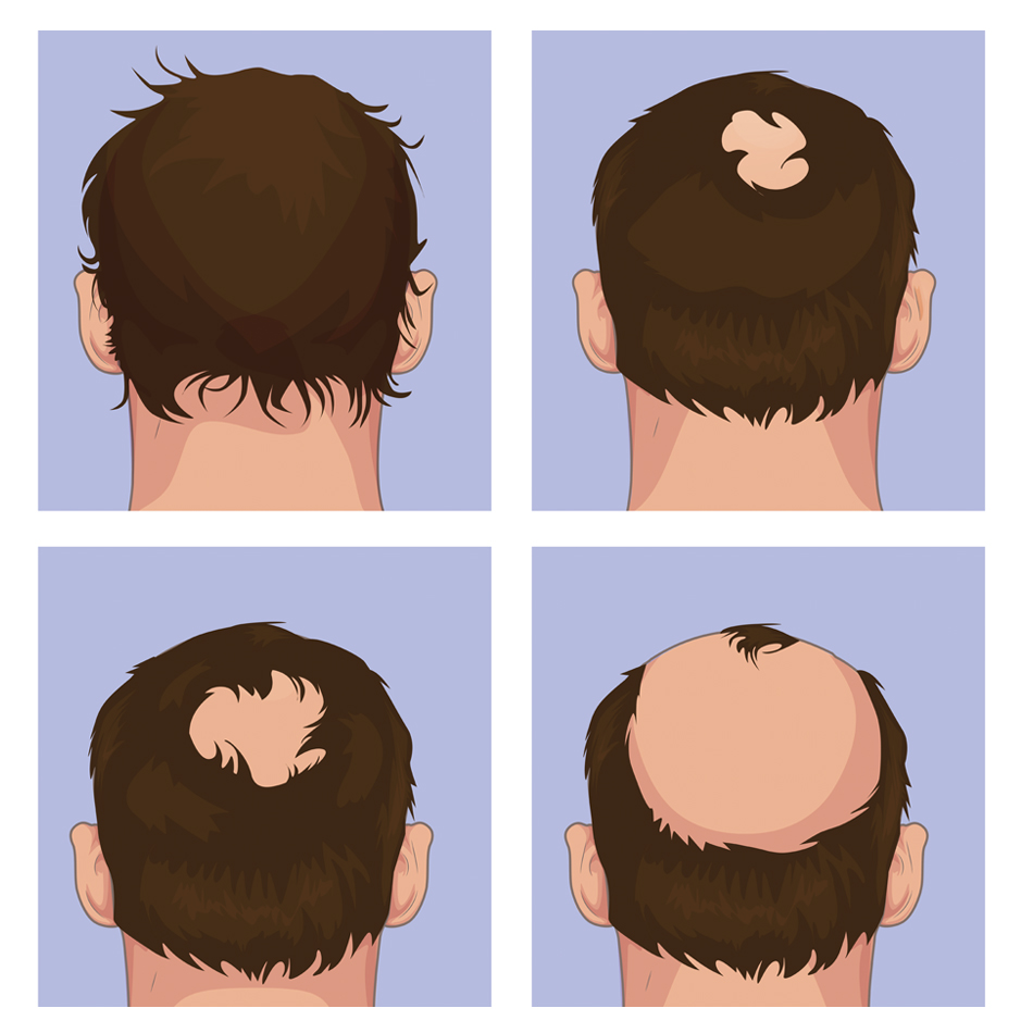 Somethings aren't inevitable.

Take a look at a genuine plant based, side effect free, alternative to Minoxidil and Finasteride.

Reseedhair.com 👍

#alopecia #patternbalding #ReseedHair #balding #hair loss #naturaltreatments #naturalproducts #Finasteride #Minoxidil