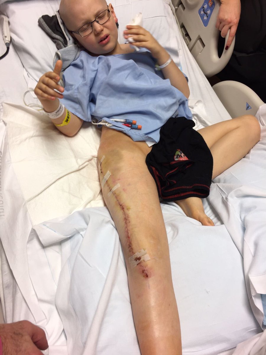 alexs_journey's tweet image. 3 years ago and just days after his first life saving surgery at Kansas University Hospital @KUHospital he had to start Physiotherapy immediately. His surgeon came in on Sunday in his own time to check up on Alex and change his bandages. We are grateful. 🇺🇸🇬🇧🦿#AlexandersJourney