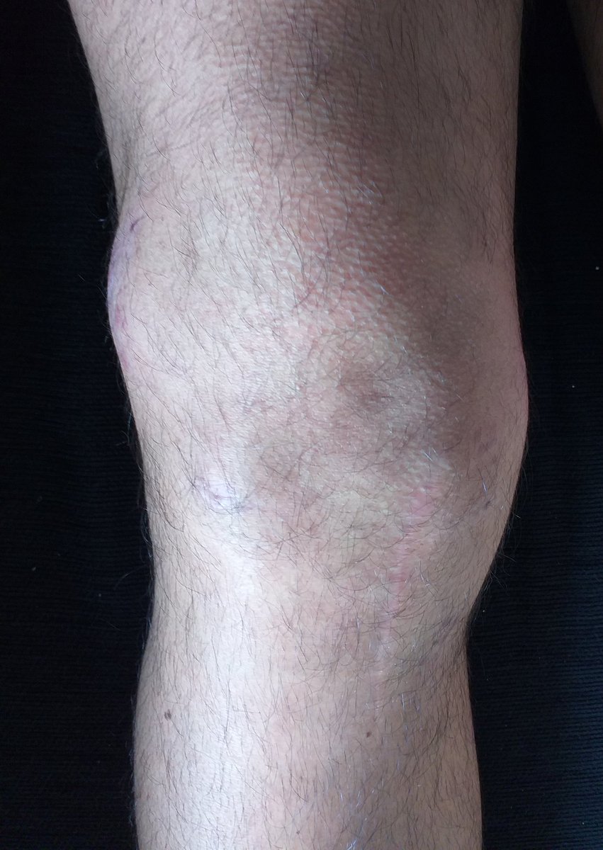 capitan_miky's tweet photo. Hoy, record en tiempo de entrenamiento. Después de dos meses y dos días, ya parece una rodilla.  Quien no se conforma es porque no quiere.
#SePuede #Rodilla #LigamentoCruzado #SeVeElFinal https://t.co/w7UdnnJFq1