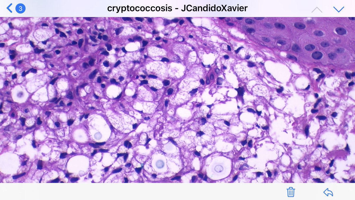 JCandidoXavier's tweet image. Cutaneous cryptococcosis: clinicians should rule out immunosuppression! #cryptococcus #tropicalmedicine #infectiousdisease #infectiouspathology #dermpath #dermatopathology #pathology #patologia #patología #dermathology