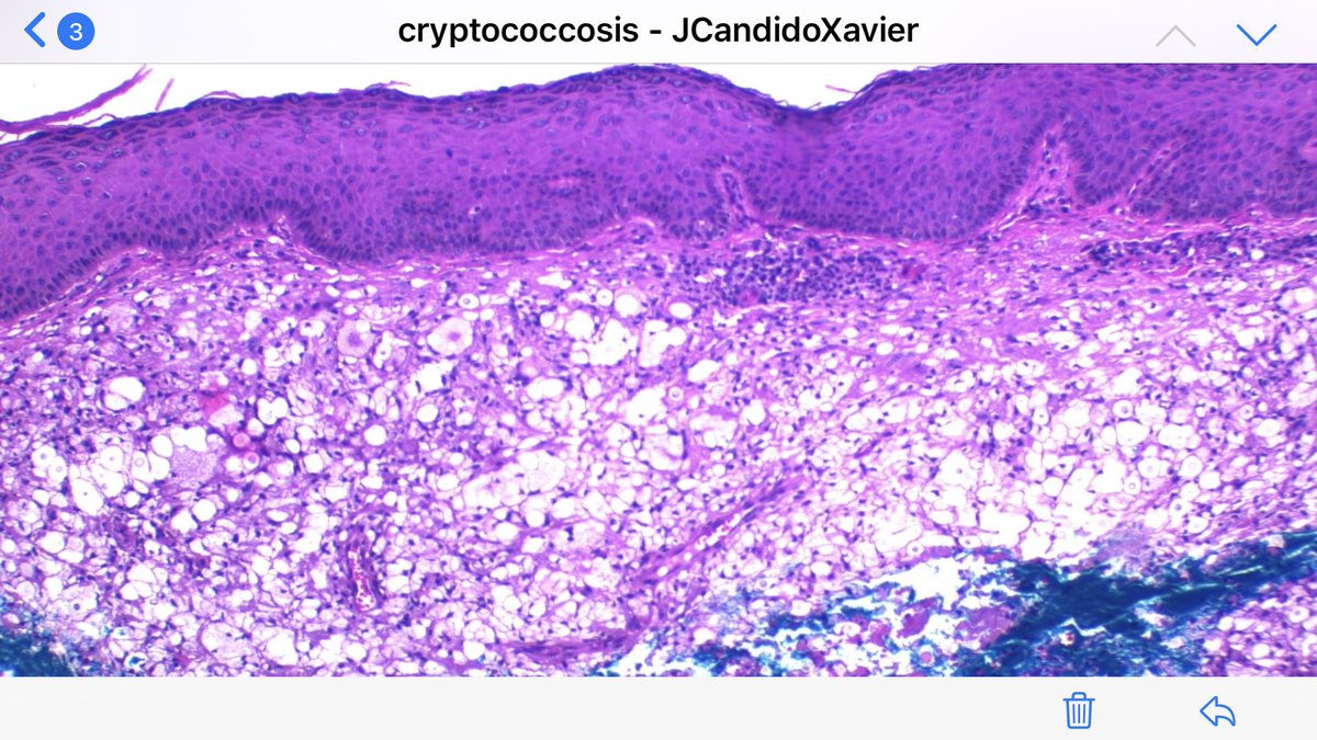 JCandidoXavier's tweet image. Cutaneous cryptococcosis: clinicians should rule out immunosuppression! #cryptococcus #tropicalmedicine #infectiousdisease #infectiouspathology #dermpath #dermatopathology #pathology #patologia #patología #dermathology