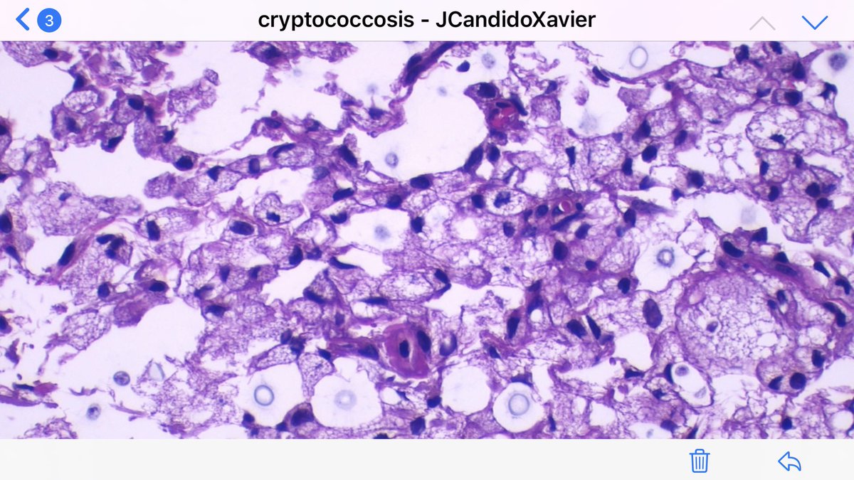 JCandidoXavier's tweet image. Cutaneous cryptococcosis: clinicians should rule out immunosuppression! #cryptococcus #tropicalmedicine #infectiousdisease #infectiouspathology #dermpath #dermatopathology #pathology #patologia #patología #dermathology