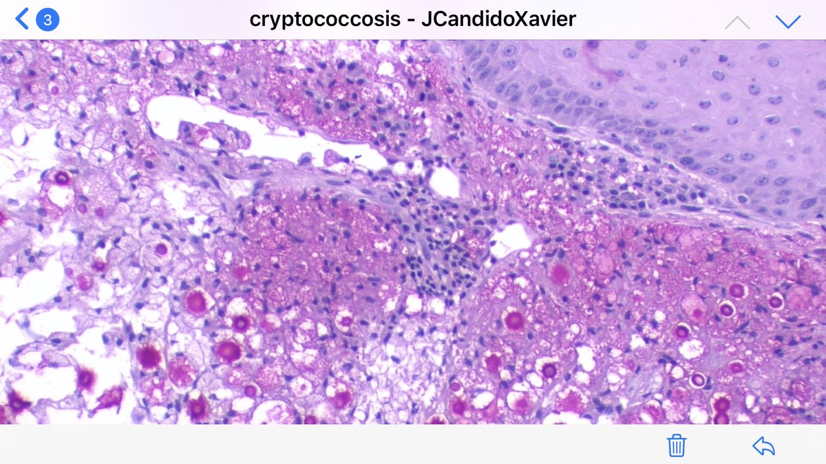 JCandidoXavier's tweet image. Cutaneous cryptococcosis: clinicians should rule out immunosuppression! #cryptococcus #tropicalmedicine #infectiousdisease #infectiouspathology #dermpath #dermatopathology #pathology #patologia #patología #dermathology
