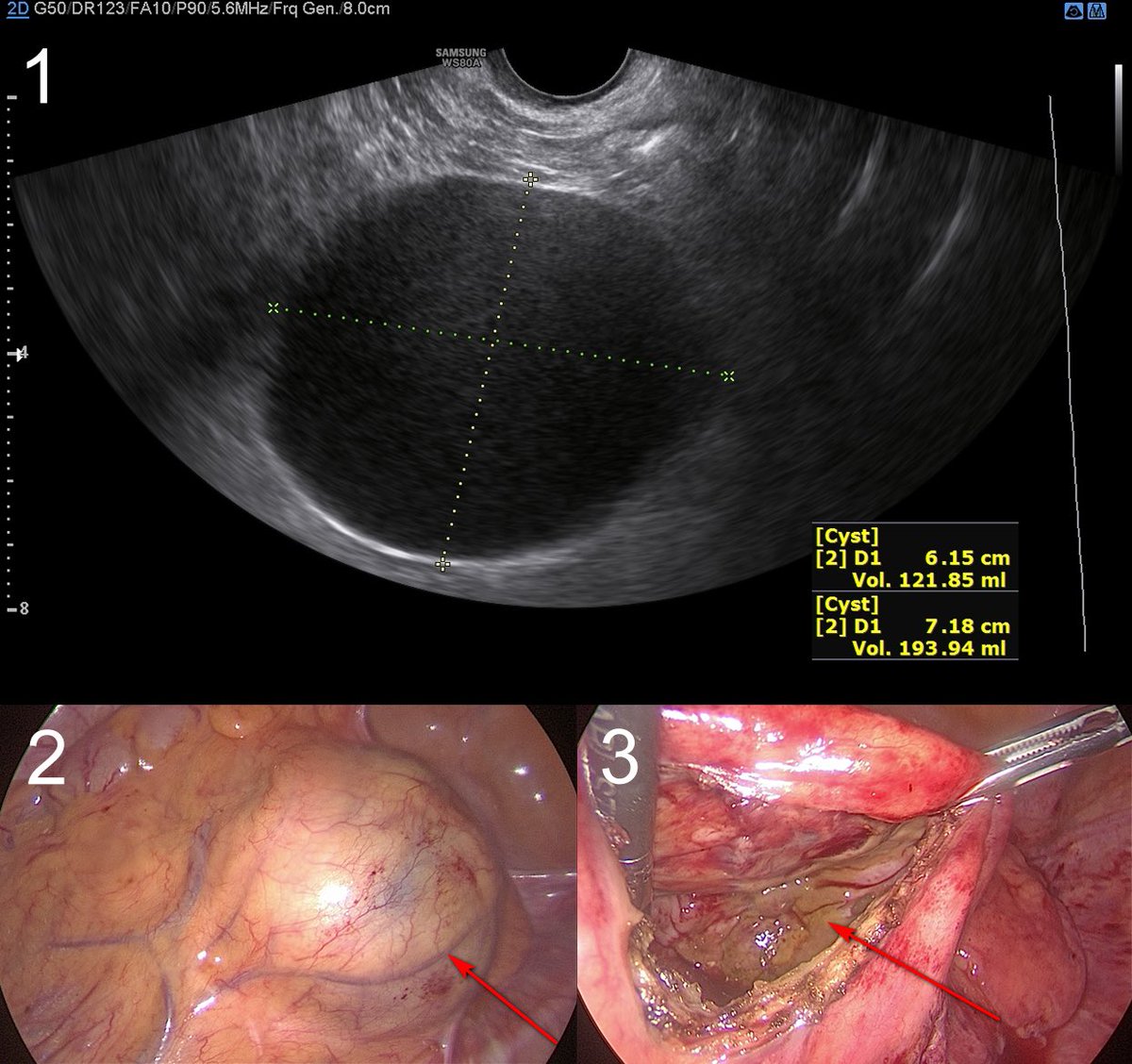 database_image's tweet photo. 📸 Laparoscopic Diagnosis Of A Mesenteric Cyst Confused With Ovarian Endometrioma

#pelvicpain #ovariancyst #sigmoidmesentery #persistenthemorrhagiccyst

🔎 https://t.co/eBeKenbx6y https://t.co/cPGCZevB5T