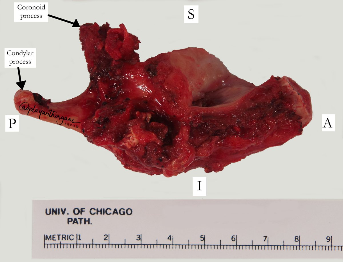 iplaywithorgans's tweet photo. Mandibulectomy tweetorial

Orient the specimen by identifying anatomic structures (such as the condylar process), looking at the type of teeth present, and by examining the curvature of the bone. 

If you’re not sure, always ask your attending

(1/6)

#GPOW #beardedPA #UofCPath https://t.co/NrTZEaLNIX