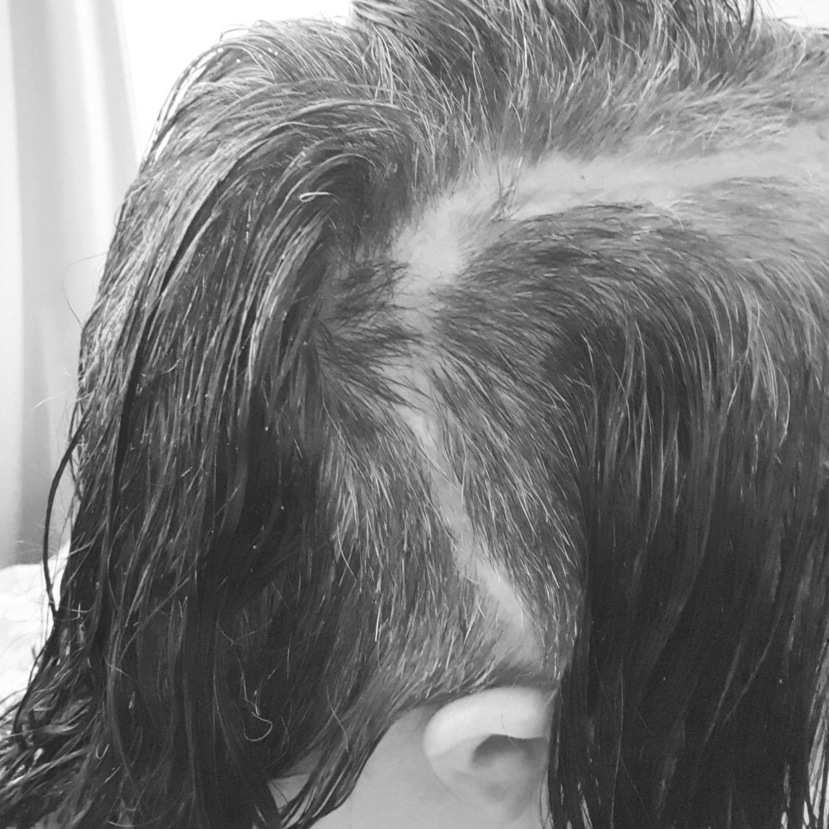 What a difference in 2 weeks just look at those tufts 👑 
Craniotomy hair can be a complete nightmare but I see the hair growth every day as a visual reminder of my recovery 🧠
....And I like it 😍
#WellnessWednesday #mybraintumourjourney #braintumourawareness