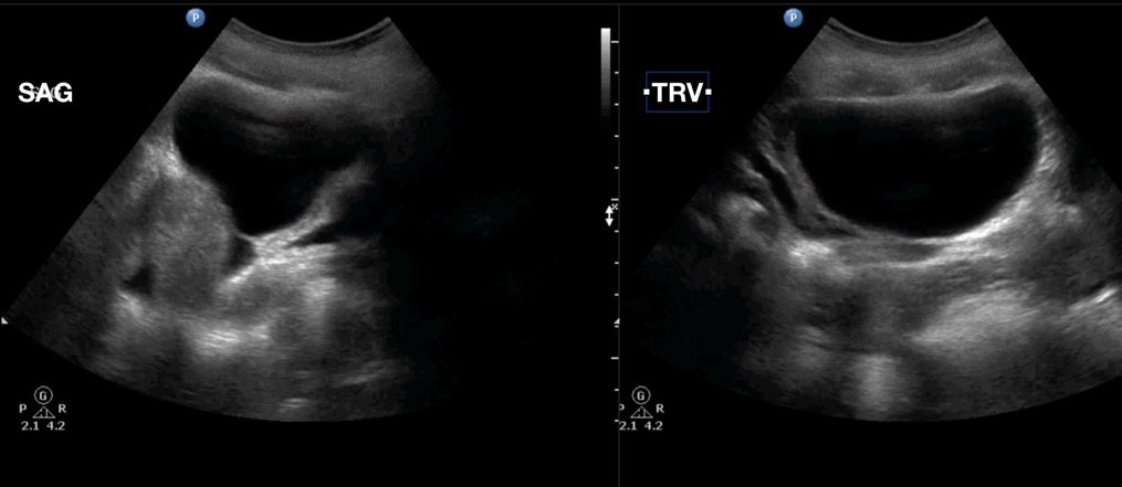 Pocus Certification Academy On Twitter Great Foamed Shows Clear Female Pelvic Anatomy Trace Amount Of Free Fluid Seen Ovarian Cyst Vs Bladder A Tricky Case Thanks For Walking Us Through It And The