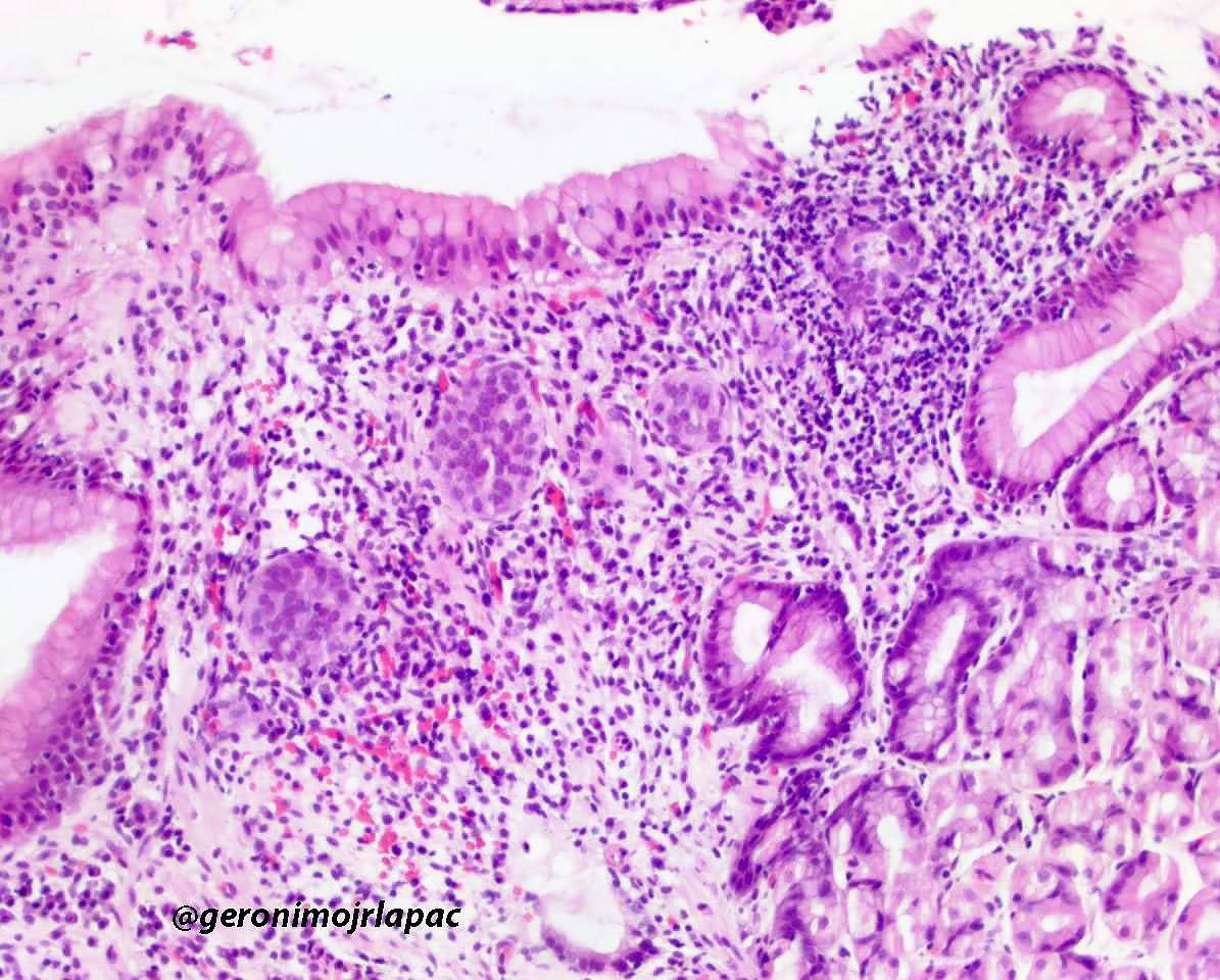 GeronimoJrLapac's tweet image. Gastric Polyp. Dx ? Residents 
#Gipath #pathology