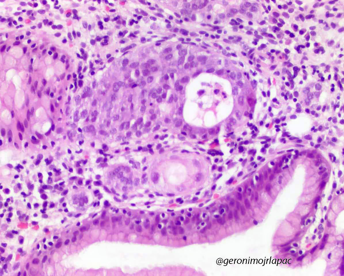 GeronimoJrLapac's tweet image. Gastric Polyp. Dx ? Residents 
#Gipath #pathology