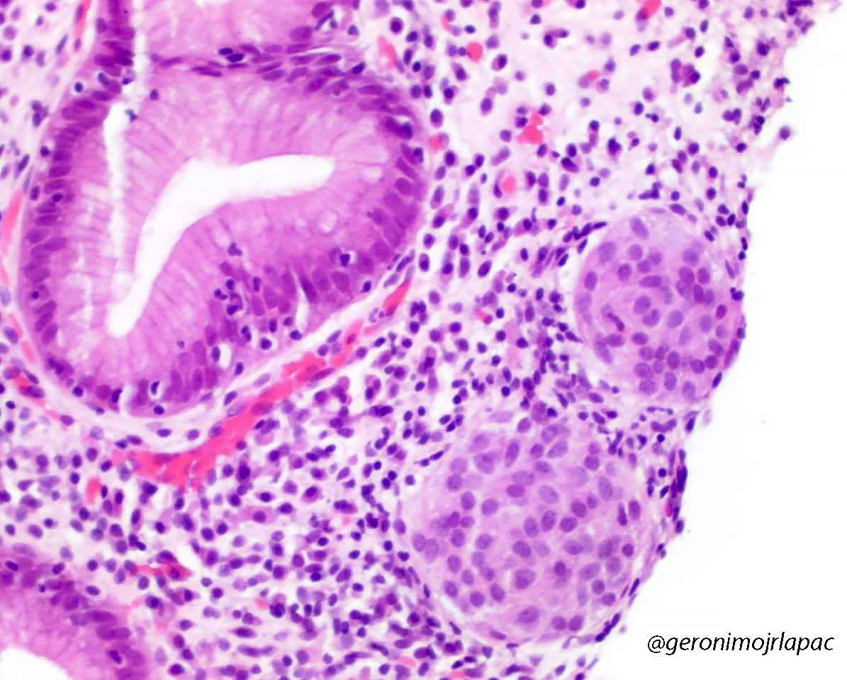 GeronimoJrLapac's tweet image. Gastric Polyp. Dx ? Residents 
#Gipath #pathology