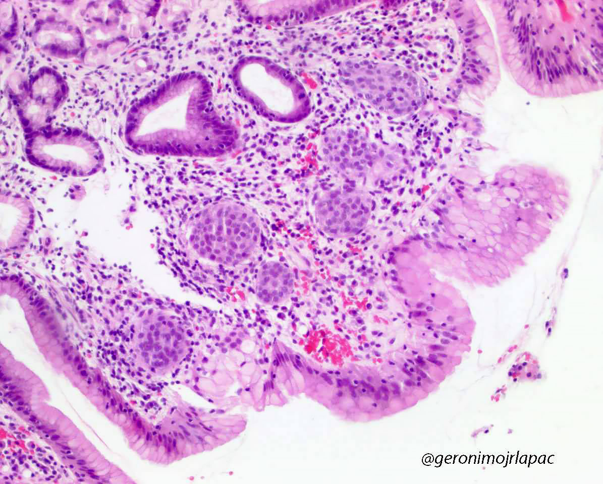 GeronimoJrLapac's tweet image. Gastric Polyp. Dx ? Residents 
#Gipath #pathology