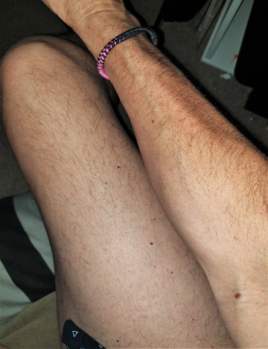 J_4Jools's tweet photo. Because for this #Transman #transguy upper thigh and forearm hair is everything!!!!
#Testosterone #Testogel doing it's thang!!
😁😁😁😁😁😁😁😁😁😁😁 https://t.co/UBnPJxIiYM