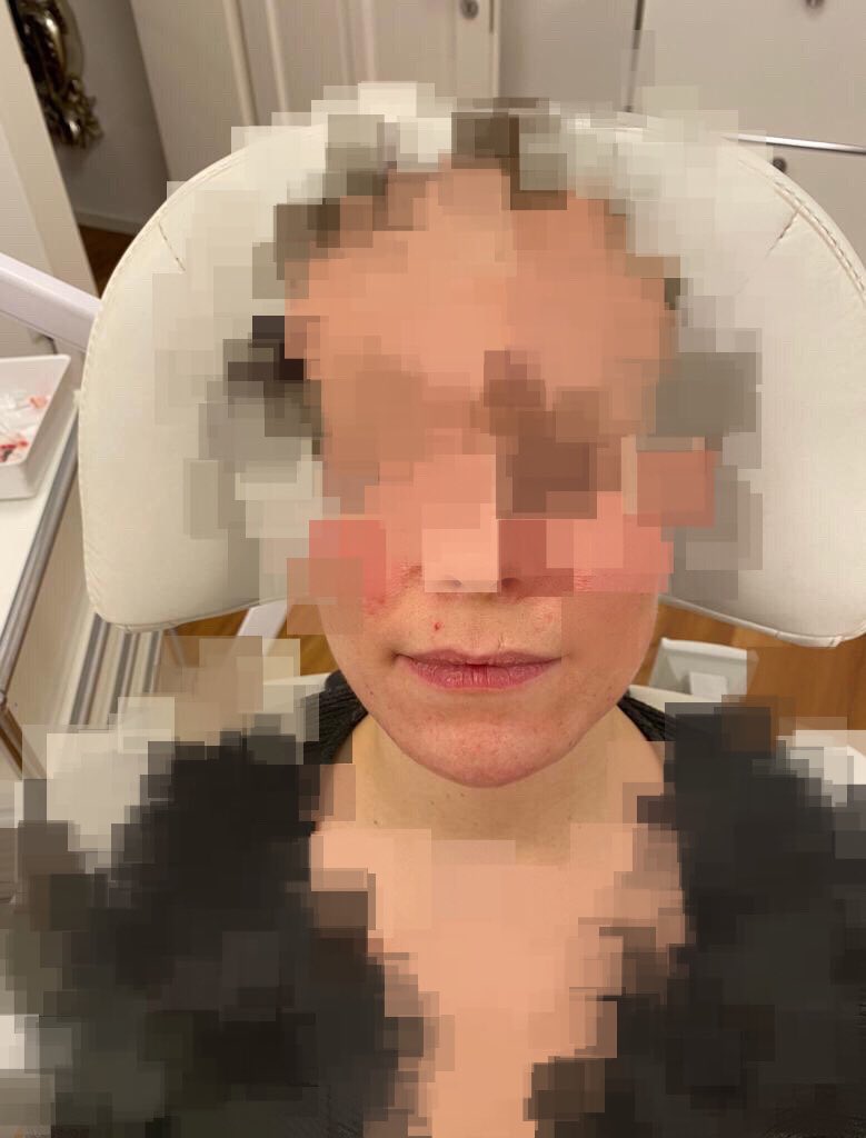 lipsandskin's tweet photo. Eine kürzliche Arbeit, mit der ich sehr zufrieden bin. Ziel war eine deutlichere V-Form des Gesichts und eine markantere Kinnlinie. (Anm.: Ergebnisse können von Patient zu Patient unterschiedlich sein und nicht wie abgebildet garantiert werden). #7PointShape https://t.co/Ek0z6fGNWG