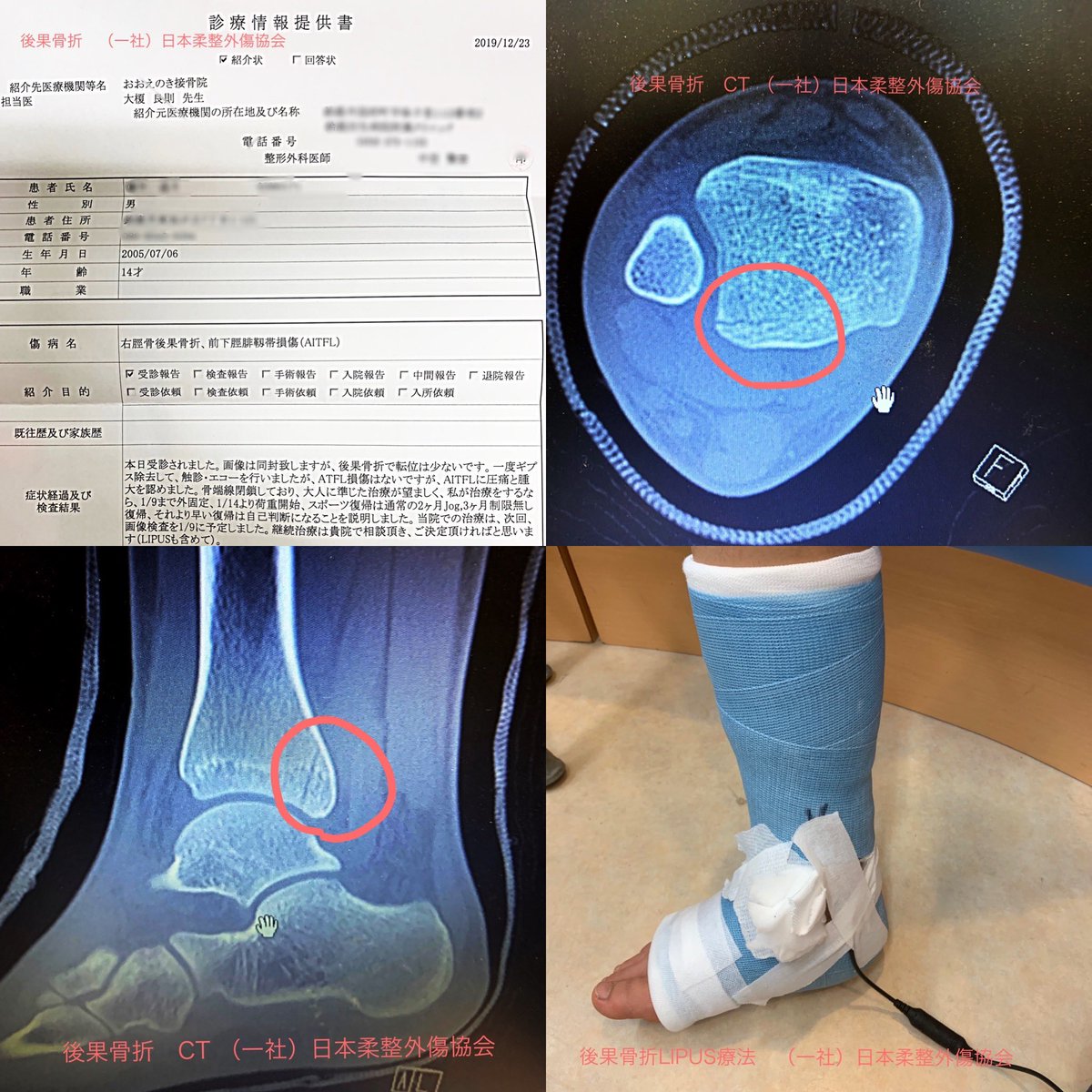 大榎良則 オステオトロンで40 骨癒合期間短縮する 今では外傷に強い接骨院に はエコーと同じくらい必須機器 ギプス中もできる優れもの 骨折は待ちの治療から攻めへ 一日10から人していきます 単価 時間 回数が大切 おおえのき接骨院