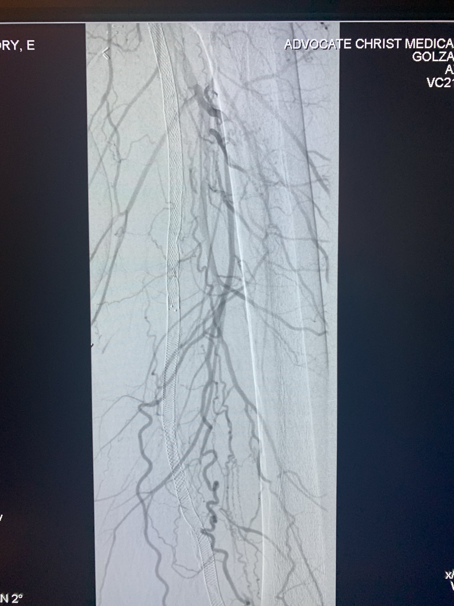 Jaafer Golzar MD FACC, FSCAI on Twitter "dualaccess lifesaver in