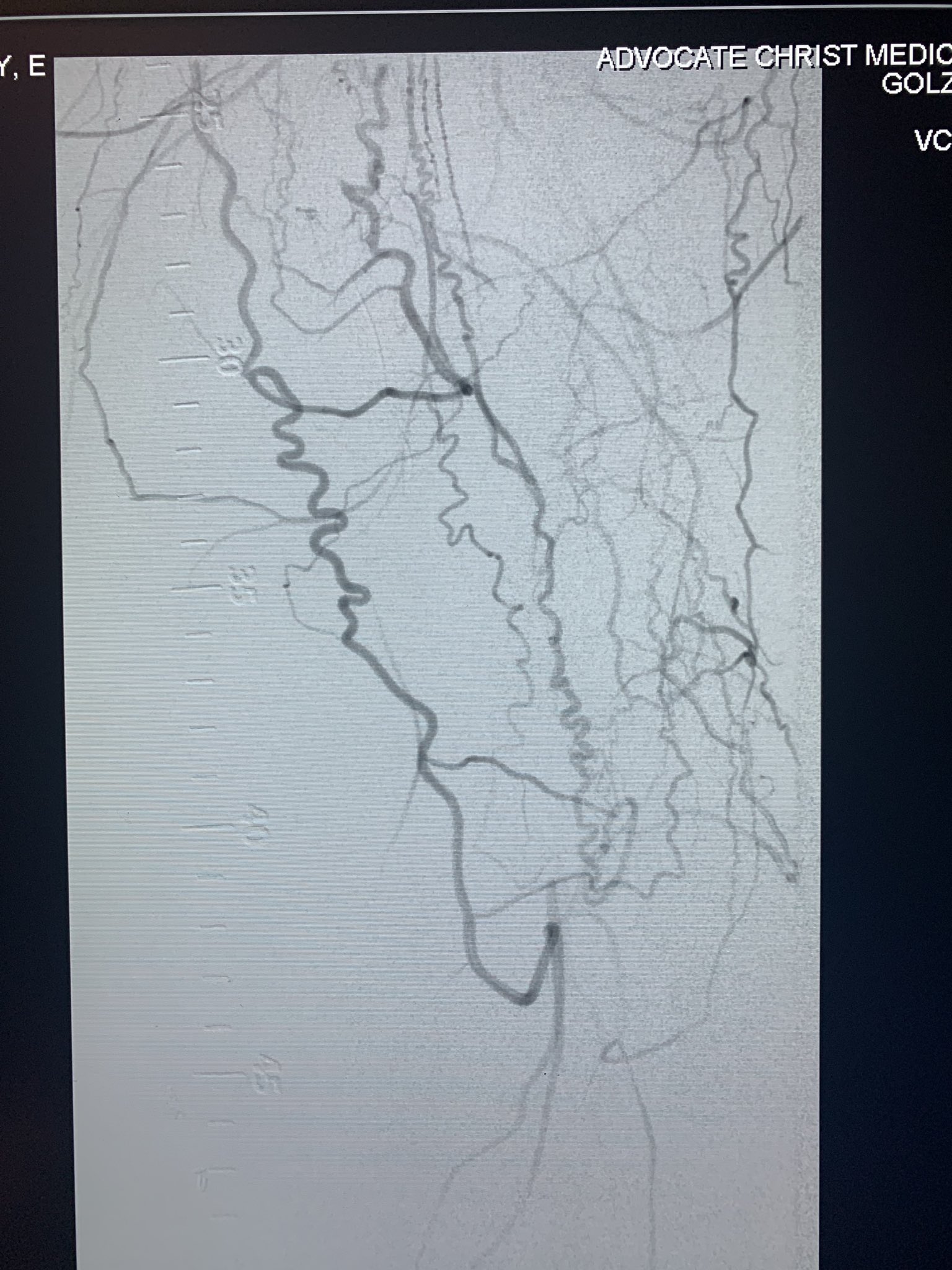 Jaafer Golzar MD FACC, FSCAI on Twitter "dualaccess lifesaver in