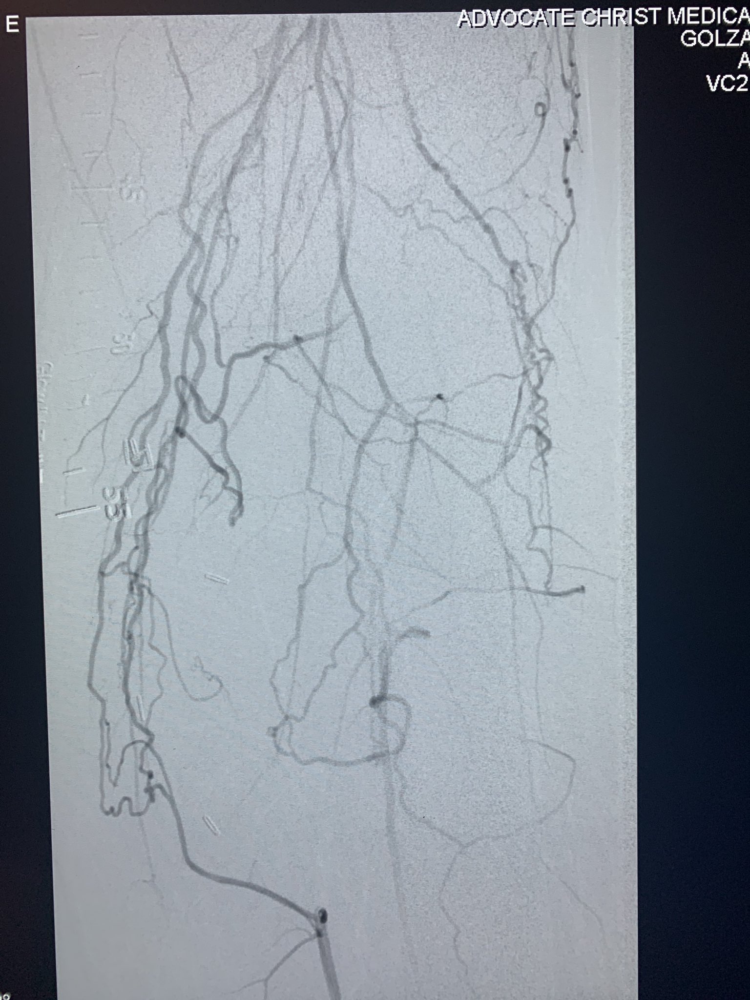 Jaafer Golzar MD FACC, FSCAI on Twitter "dualaccess lifesaver in