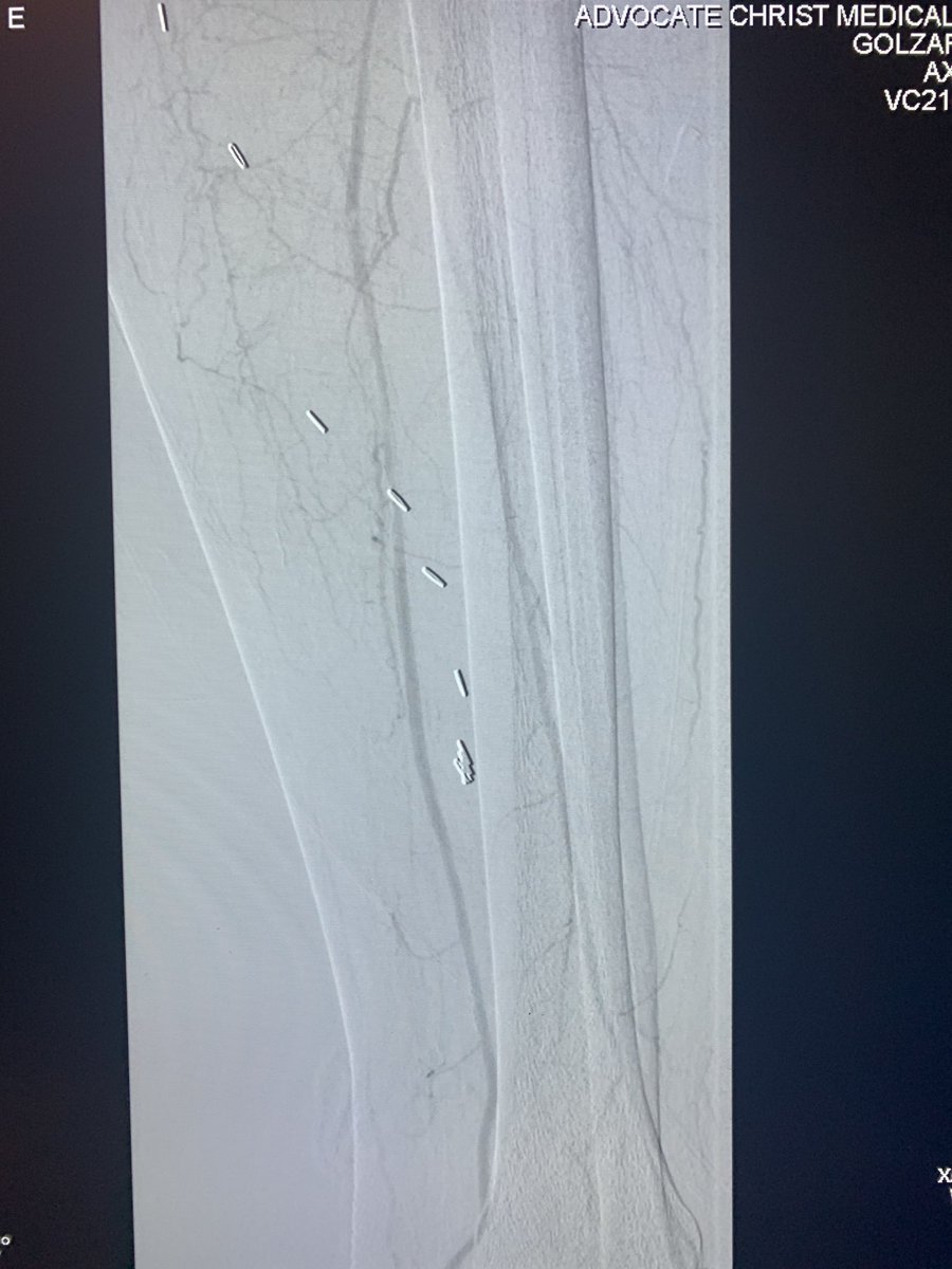 Jaafer Golzar MD FACC, FSCAI on Twitter "dualaccess lifesaver in