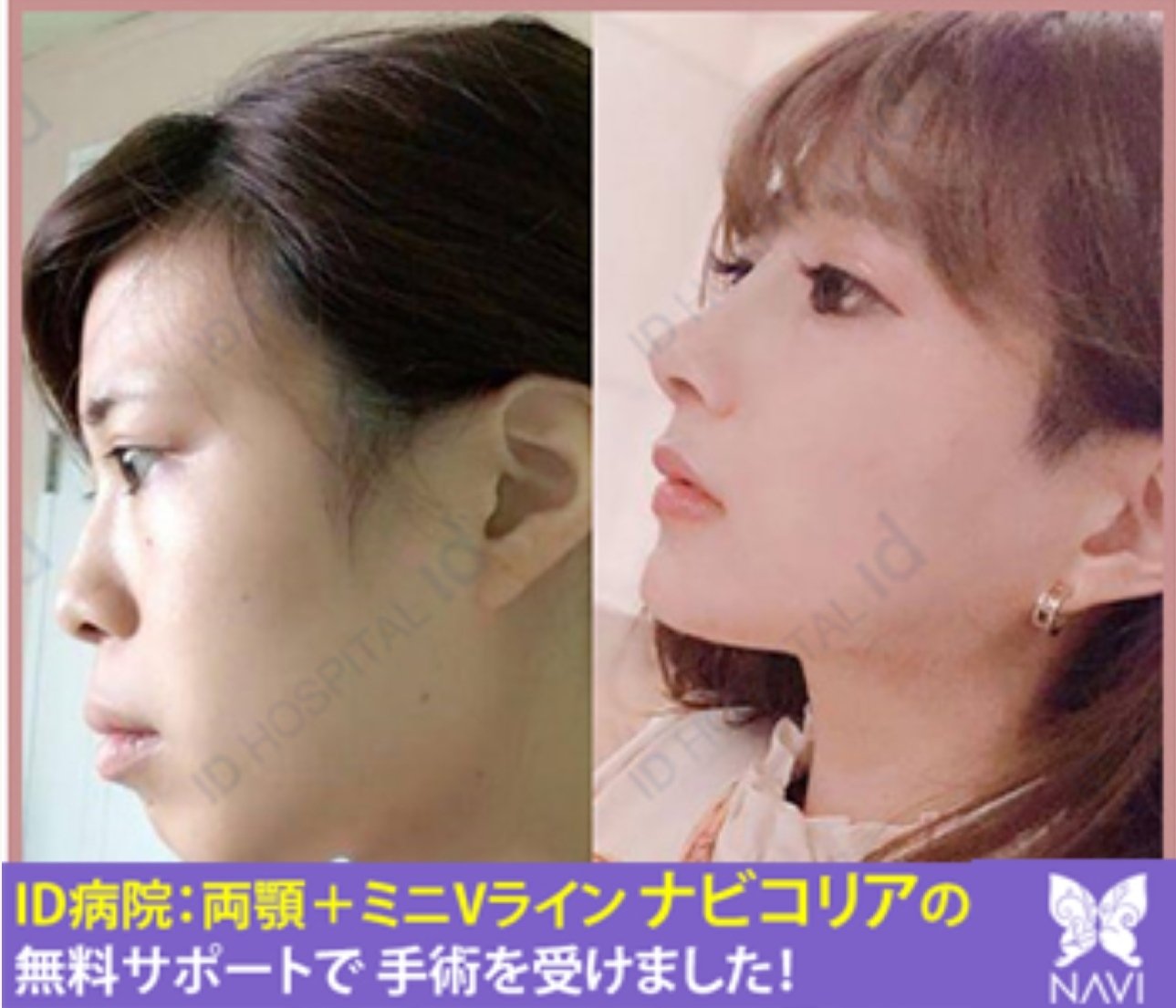ナビコリア 韓国美容整形 無料サポート 08年から 韓国で骨手術 輪郭形成 頬骨縮小 エラ 削り 顎先 バッカルファット エラの筋肉等も 料で切除もしてくれる 両顎手術 相談会特典割引 最大40 オフ 最大泊 韓国整形 Id美容