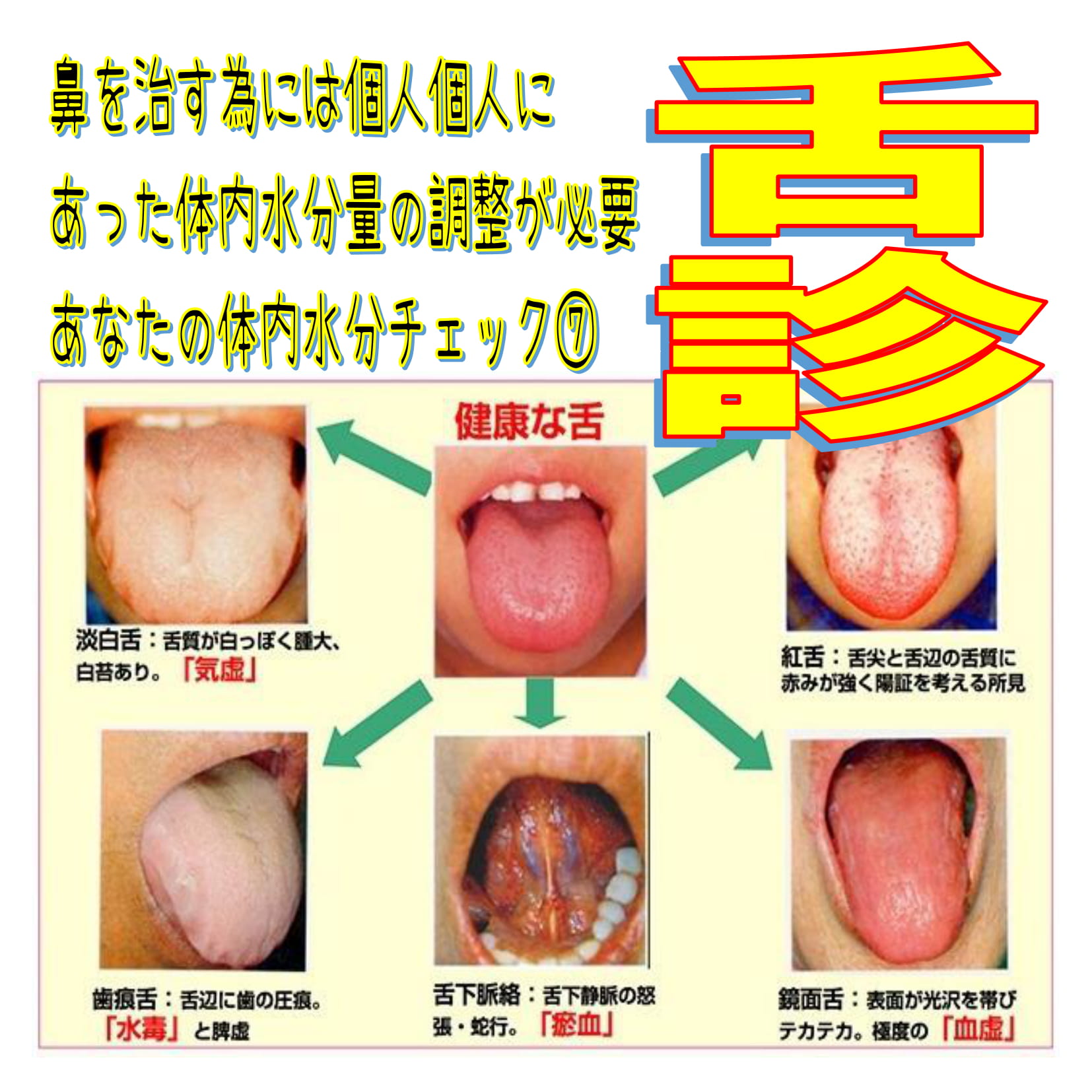 三宅兵衛 ﾐﾔｹﾋｮｳｴ三宅やすらぎ堂 در توییتر 水分過剰になった時に出てくる症状 舌診 まず 鏡を持ってベーしてみてください 舌がぼってり デカい感じじゃないですか 舌のふちに歯型のような痕 ｱﾄがついていませんか 今 鏡を見ようとした時 一瞬 唾を