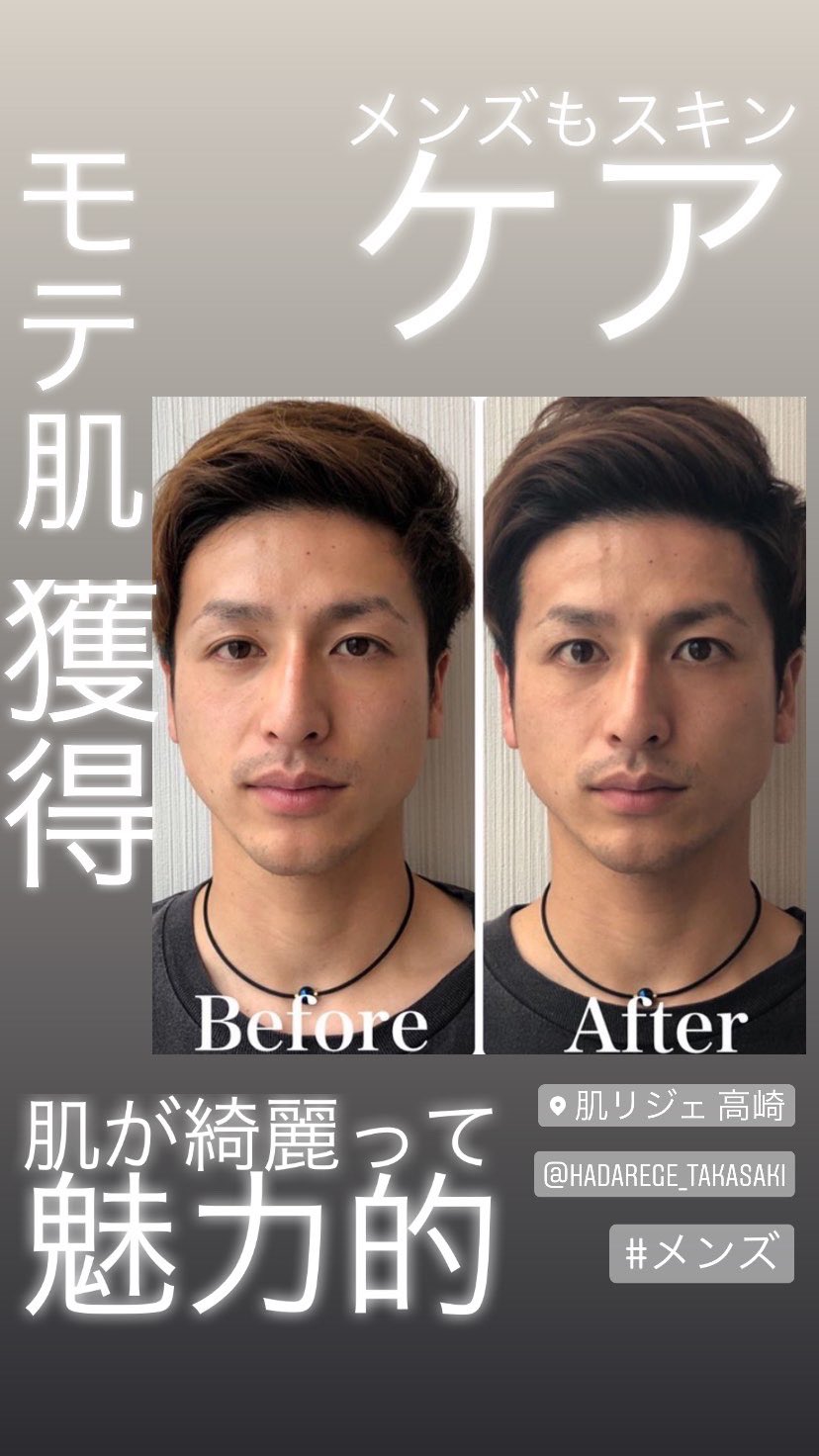 肌リジェ高崎 モテ肌獲得 女性も憧れてしまうような お肌の男性ってとても 魅力的ですよね あなたもモテ肌を手に入れましょう モテ モテモテ 肌荒れ メンズ 高崎 美容 メンズエステ メンズモデル メンズファッション メンズアイドル 肌リジェ高崎 モテ肌獲得 女性も憧れてしまうような お肌の男性ってとても 魅力的ですよね あなたもモテ肌を手に入れましょう モテ モテモテ 肌荒れ メンズ 高崎 美容 メンズエステ メンズモデル メンズファッション メンズアイドル