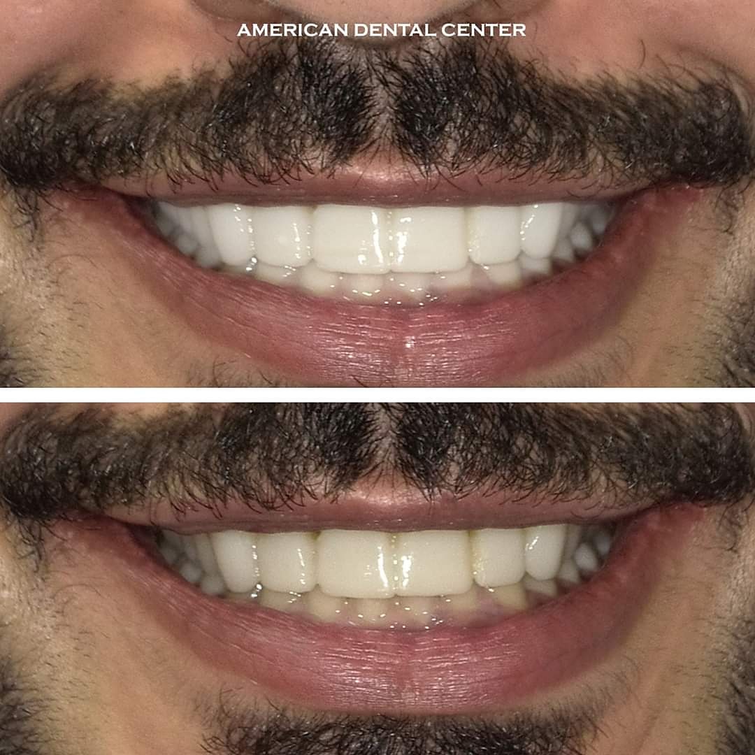 adcmuscat's tweet photo. For a brighter, whiter smile why not book yourself in for our professional teeth whitening - we even give you an aftercare &amp; maintenance kit for long lasting results!
#adcoman #adcmuscat #oman #عمان #مسقط #طبيب_اسنان_عمان #طبيب_اسنان_مسقط #طبيب_اسنان #اعتني_باسنانك #عناية_الاسنان https://t.co/i0kSz2JpxN