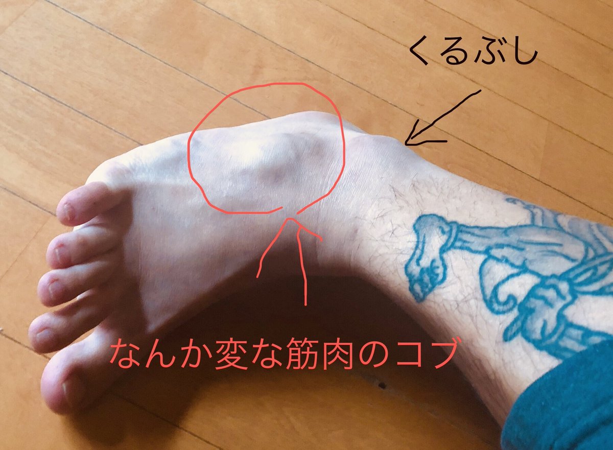 Garu 雅流 悲報 足の甲に刺青いく予定だったのに謎の筋肉痛のコブのせいで断念 突然変異 人間には無いもの Garu 雅流 悲報 足の甲に刺青いく予定だったのに謎の筋肉痛のコブのせいで断念 突然変異 人間には無いもの