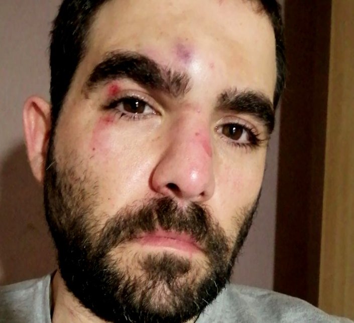 Esta es mi nueva cara tras pasarme la madrugada entre el hospital y la comisaría. Esta noche pasada me quisieron robar el móvil. Al negarme, pasaron a la acción. Un individuo me ha atacado  mientras un grupo de hombres le custodiaba. Ha pasado en el Raval, en Barcelona.