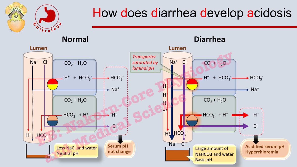 NNakorn5's tweet photo. หลังจากเลคเชอร์อาเจียนไปแล้ว วันนี้เรามาเจอ diarrhea กันต่อ 🤯
🌵🌵🌵ทำไม #Diarrhea ถึงทำให้เกิดภาวะ #metabolic #acidosis with #hyperchloremia❓ 👉🏻 ตอนที่ 1 : "Diarrhea ทำให้เกิดภาวะ Metabolic acidosis ได้อย่างไร? " #นสพ #นศพ #แพทย์ https://t.co/JM2JN5zFgj