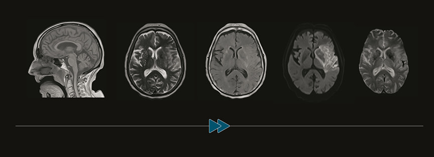 #RSNA2019 : Ultrafast brain MRI valid alternative to CT for emergent patients with non- traumatic neurological symptoms bit.ly/30pkeZ3 #radiology #imaging