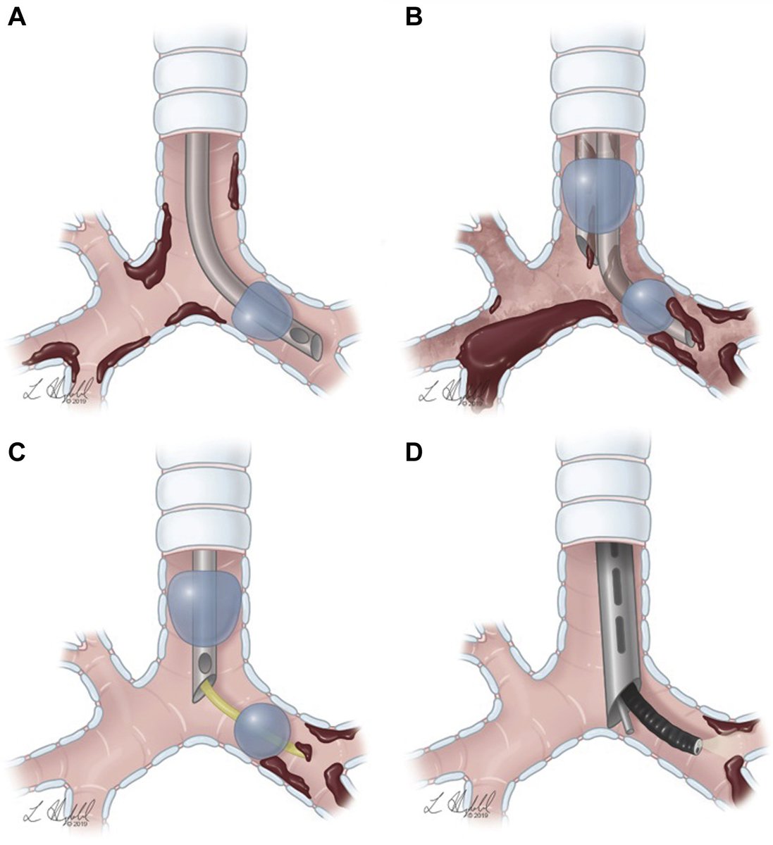 accpchest's tweet photo. Management of massive life-threatening hemoptysis: A #CHESTReview in this month’s #journalCHEST https://t.co/kzg4hD8r91 https://t.co/H4lPSjo0nd