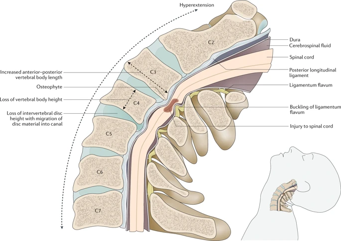 KarimMithaniMD's tweet photo. State-of-the-art review and update on degenerative cervical myelopathy by @UofTNeuroSurge scientists, via @NatRevNeurol 

Future directions: RCTs on optimal surgical approach, role of perioperative riluzole, and neuroimaging + serological biomarkers

https://t.co/cMdteTfuoJ https://t.co/DfgYpZGm4T
