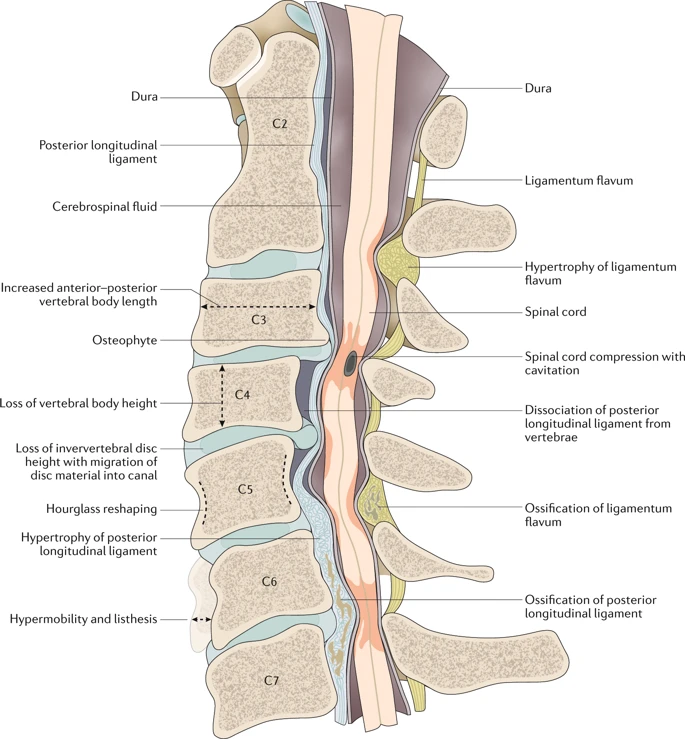 KarimMithaniMD's tweet photo. State-of-the-art review and update on degenerative cervical myelopathy by @UofTNeuroSurge scientists, via @NatRevNeurol 

Future directions: RCTs on optimal surgical approach, role of perioperative riluzole, and neuroimaging + serological biomarkers

https://t.co/cMdteTfuoJ https://t.co/DfgYpZGm4T
