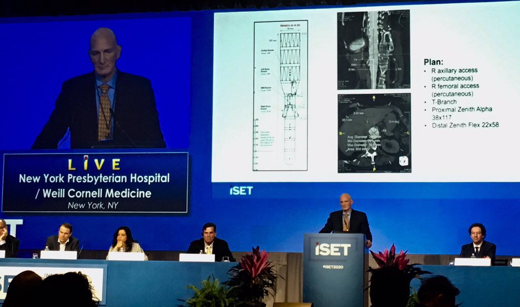 Watching 3rd endovascular aortic repair of the day. This time with the pros @WeillCornell @NYCVascular  @VascularMD. Perfect follow up to morning session on need for off the shelf fEVAR! Here IDE only TBrach device #iset2020 @ISETNews @AudibleBleeding @SIRRFS @SIRspecialists