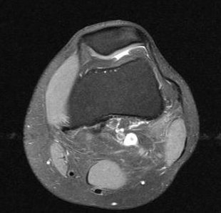 shields_health's tweet photo. Time to play: Guess that MRI!

What body part is in the MRI below? (Hint: we see a lot of these during ski season) https://t.co/HIkcrQSl3L