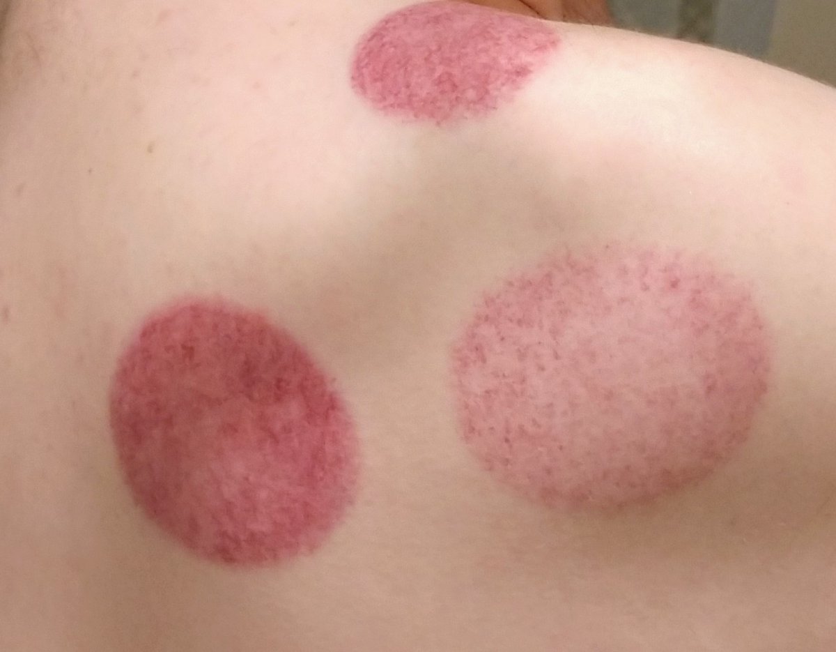 Pre-bruising pic of back/shoulder following cupping